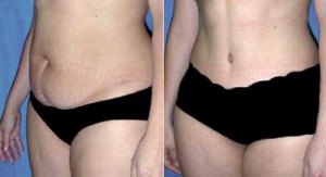 tummy tuck abdominoplasty - Liposuction Miami, Liposculpture