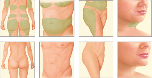 Liposuction and LipoSculpting - Liposuction Miami, Liposculpture